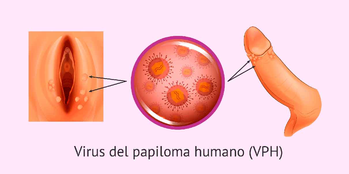 VPH