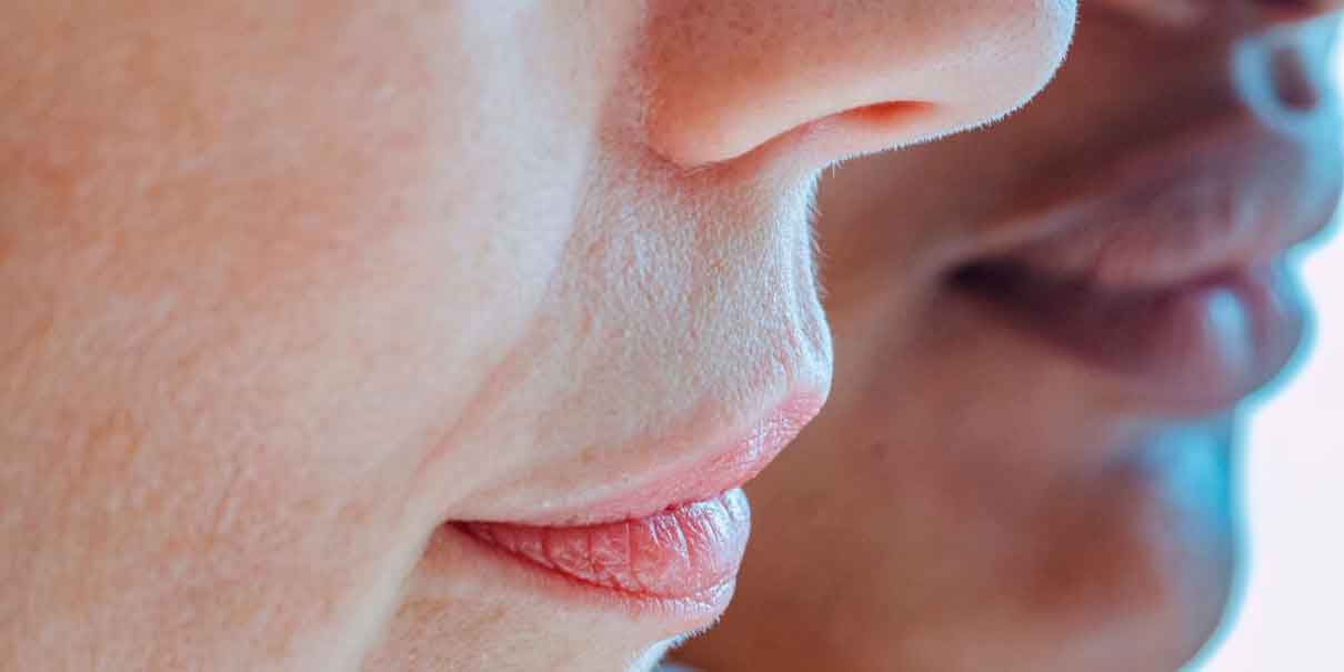 Melasma