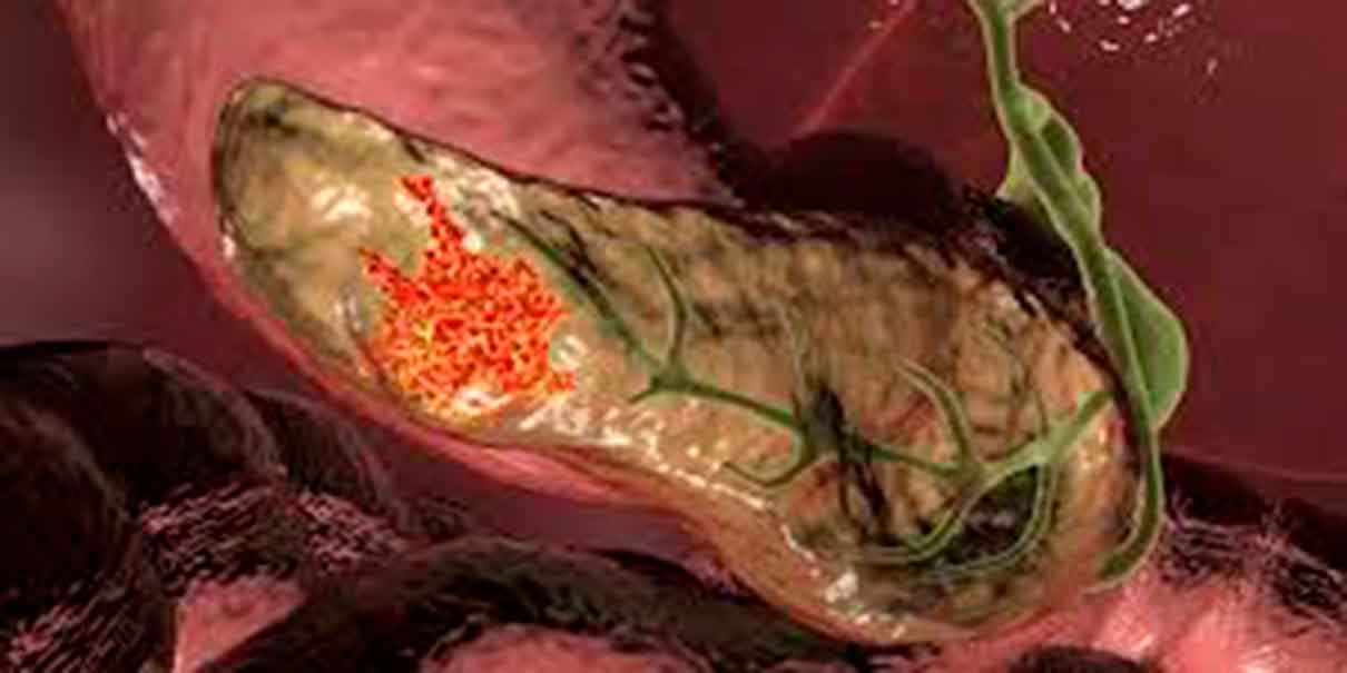 Cáncer de páncreas