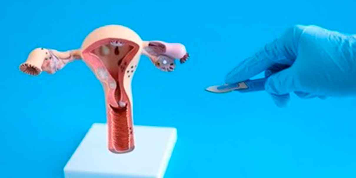 Rejuvenecimiento vaginal 
