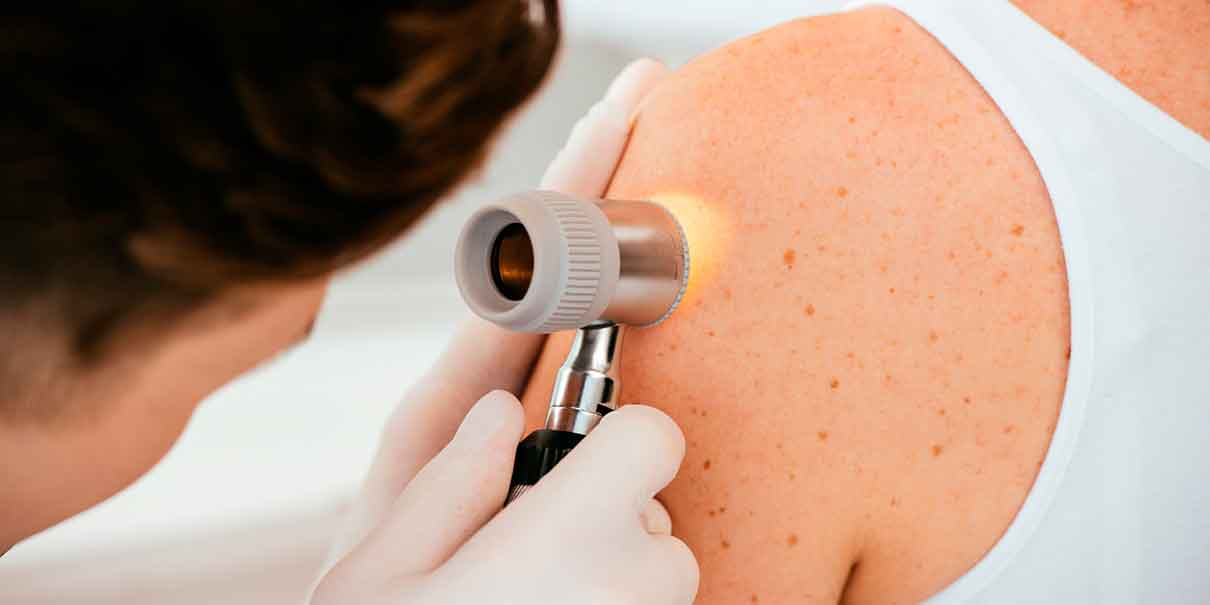 Herpes en la piel