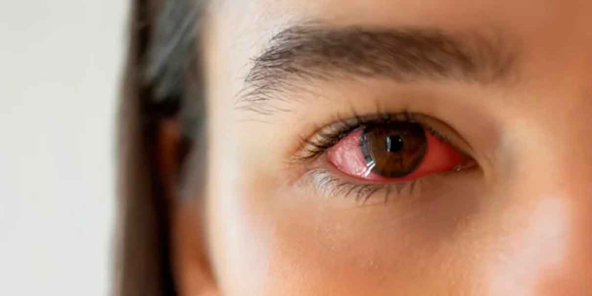 ojo seco