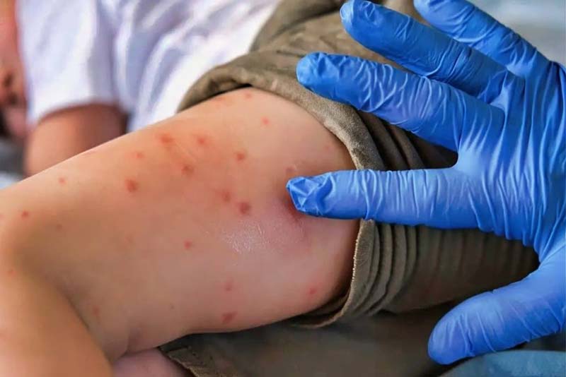 Puebla reporta 66 casos de sarampión y llama a extremar precauciones