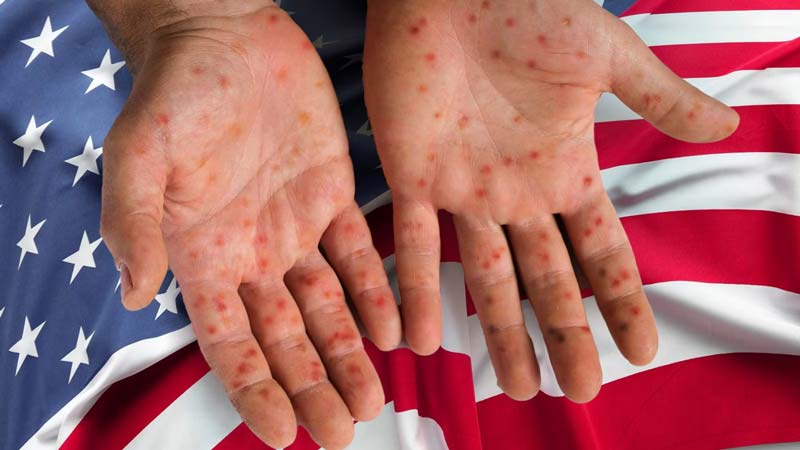 Sarampión en México: el país lidera contagios en América y enciende alertas sanitarias