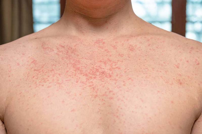 Sarampión fuera de control: activan cubrebocas obligatorio en estos estados