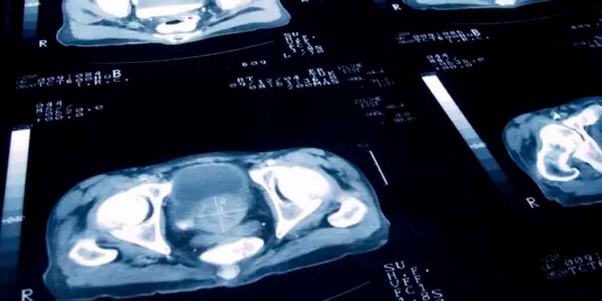 cáncer de próstata