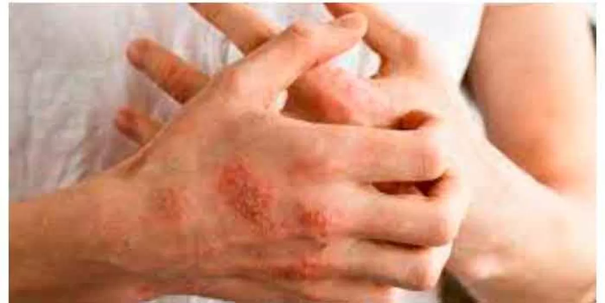 Autoridades de EU advierten que la lepra se habría convertido en una enfermedad endémica