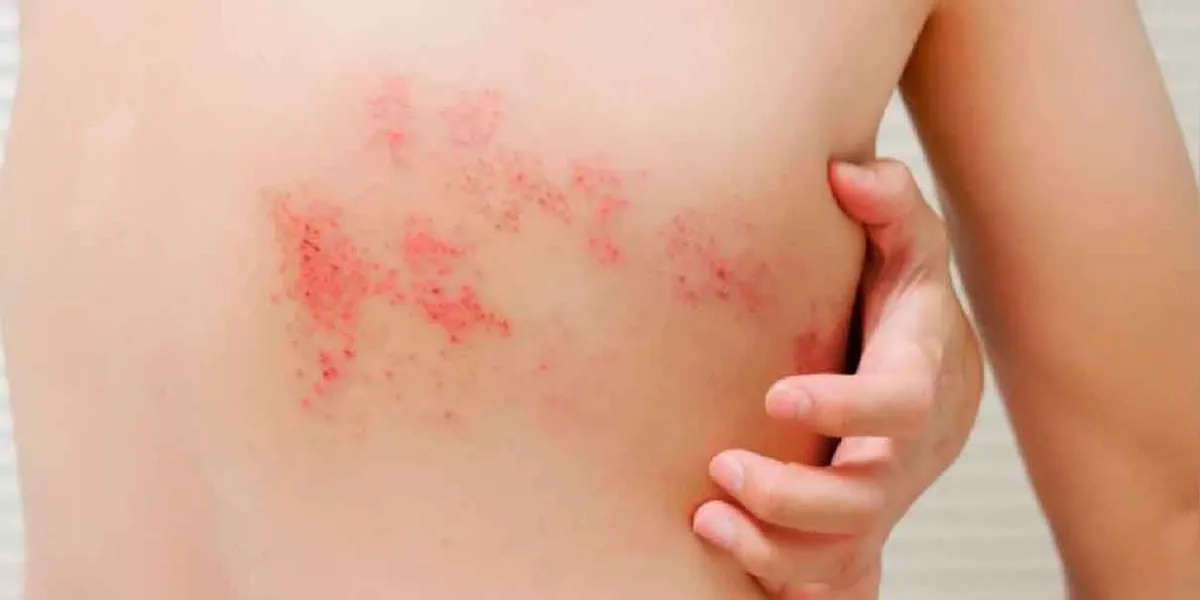 Científicos prueban con éxito un virus del herpes para combatir el cáncer de piel avanzado