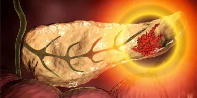 Terapia experimental logra curar el CÁNCER de páncreas más agresivo en RATONES