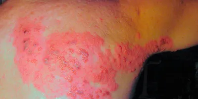 Culebrilla: por qué el herpes zóster es más peligroso en personas con enfermedades crónicas