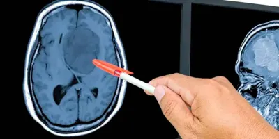 Testosterona podría ayudar a frenar el glioblastoma, según estudio 