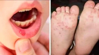 Alertan de brote de virus Coxsackie en primaria de Puebla: Se toman medidas preventivas