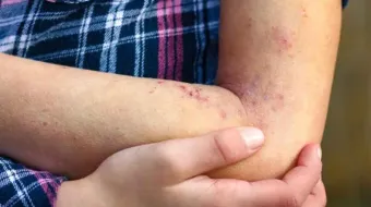 Enfermos de Lupus podrían recibir atención médica por ley