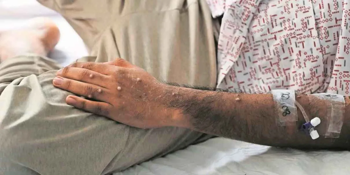 Cifra de casos positivos de mpox en Puebla se mantiene