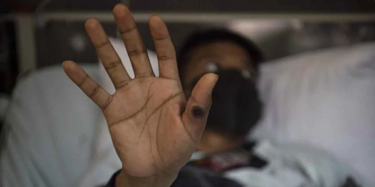 México 2024: Alerta por el aumento de casos de viruela del mono en el país