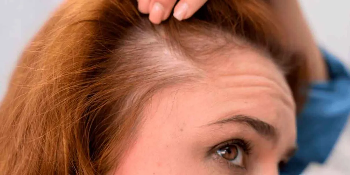 El estrés: Un factor clave en la caída del cabello y cómo combatirlo