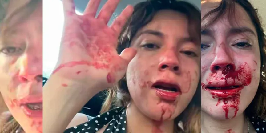 Joven denuncia agresión de su novio en Cuernavaca; caso reaviva debate sobre violencia contra las mujeres en Morelos
